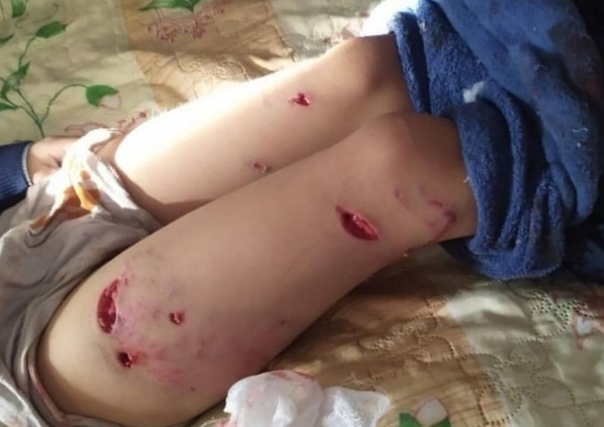 В Улан-Удэ стая собак напала на первоклассника Малыш возвращался домой после учёбы и никак не провоцировал животных.Ребёнка сильно покусали, у него буквально вырваны куски тела, а также сломана